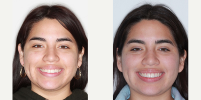 Adult Female Seeking Re-treatment for Crowded Teeth - Age: 18 - 29Gender: FemaleProcedure: Clear Ceramic BracesThis adult female patient came to the doctor for re-treatment. Her smile was already great as she had braces 10 years ago already, but she lost her retainers (like many of our adult patients). This caused her teeth to shift and she wanted to get her teeth perfect again. Her treatment took 1 year. We were able to improve her smile arc so that it better matches the beautiful natural curve her lip.