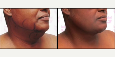 Woman treated with Chin Liposuction - Before & After: The Power of Chin Lipo with Renuvion