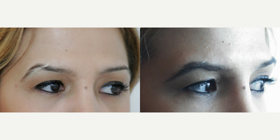 25-34 year old woman treated with Eyebrow Transplant - The result of 8 months - Eyebrow transplant surgery