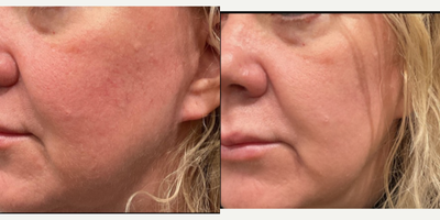 45-54 year old woman treated with IPL - 45-54 year old woman treated with IPL- Lumecca