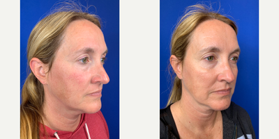 45-54 year old woman treated with IPL for Rosacea - Patient treated with IPL for rosacea before and one month after procedure, showing reduced redness and signs of rosacea. Patient also applied Skinceuticals skincare products to complement IPL treatment and increase effectiveness.