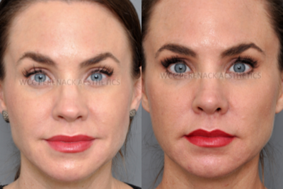 35-44 year old woman treated with Revision Rhinoplasty - This patient received a Rhinoplasty by another surgeon years prior to coming to us for a Revision Rhinoplasty.