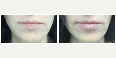 55-64 year old woman treated with Restylane Silk - 55-64 year old woman treated with Restylane Silk