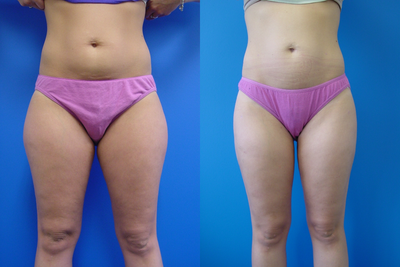 Liposuction - 
	This patient underwent liposuction of the circumferential thighs, bilateral flanks, and periumbilical area.

