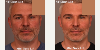 Man treated with Mini Neck Lift - Man treated with Mini Neck Lift