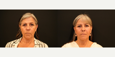 55-64 year old woman treated with Facelift, Neck Lift, TCA Peel - Face/Neck Lift with TCA Peel and Fat Grafting
