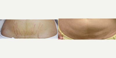 Laser Stretch Mark Removal with Vbeam Pulsed Dye laser. - Patient wanted to address red and textured stretch marks post pregnancy.  We used the Aramis and Pulsed Dye laser to improve color and texture of the stretch marks.  Red stretch marks before and after pictures Los Angeles.