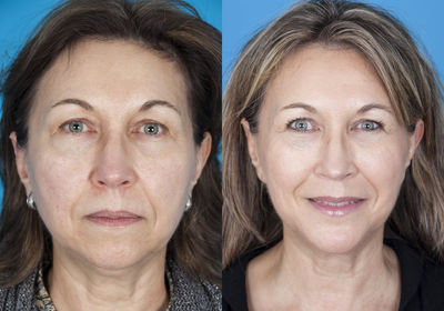 56 yo female with sleep apnea and microgenia (small chin)  - 56 yo female with sleep apnea and microgenia (small chin) treated by Dr. Jose Barrera with sliding genioplasty chin surgery.