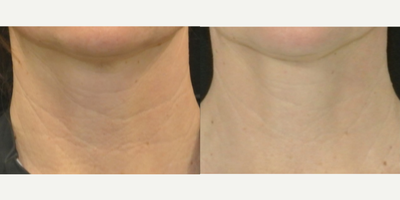 44 year old woman treated with Skintyte - This 44 year old female received five skin tightening sessions on her neck to improve the wrinkles.