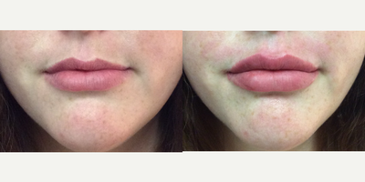 Vollure Lip Filler for this 26 Year Old Woman - This 26-year old female had her lips filled with 1ml of Juvederm Vollure. The results are immediate with no down time.