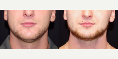 18-24 year old man treated with CoolSculpting to the Chin; 2 months post-op - 24 year old male received one CoolMini treatment to the chin; photos depict the patient's results at 2 months post-op.