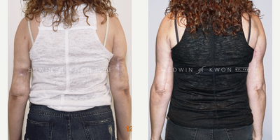 45-54 year old woman treated with Scar Removal - 45-54 year old woman treated with full thickness skin loss on posterior arms following VASER liposuction. Patient's arms were treated with 3 rounds of fat transfer with excision of the contracted scar as a final stage reconstruction. Patient continuing to undergo microneedling of the surgical scar.