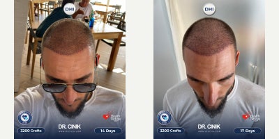 25-34 year old man treated with DHI Hair Transplant - For the well-known football player Nemanja Gudelj, a total of 4700 grafts were transplanted using the DHI technique, with implantation focused on the frontal, mid-scalp, and crown areas to achieve balanced density and natural coverage.