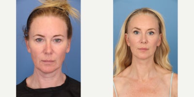 45-54 year old woman treated with Deep Plane Facelift, Neck Lift, Brow Lift, Facial Fat Transfer - After only 6 weeks out from facial rejuvenation surgery our patient is healing nicely. She still has a lot of swelling which will subside over the next year. Dr. Balikian performed Preservation Deep Plane Facelift, Vertical Deep Neck Lift, Temporal Brow Lift and Fat Transfer to Partial Face.