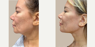 45-54 year old woman treated with Nonsurgical Facelift, Nonsurgical Neck Lift, Renuvion, Skin Tightening - Combining these 3 cutting-edge procedures, we can create a new foundation and youthful structure to the face & neck. Benefits of the SurgYlift:* Rejuvenation for the face and the neck* Improves definition in the midface and jawline* Reduces under-eye hollowness* Minimally invasive* No scarring* Long-lasting results
