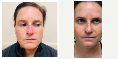 25-34 year old woman treated with Lumecca - 5 IPL (Lumecca) treatments to improve broken blood vessels