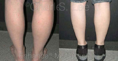 Calf reduction - Non-surgical Calf reduction