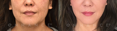45-54 year old woman treated with Thread Lift - 2 days after thread lift