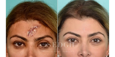 45-54 year old woman treated with Scar Removal - This 48F patient experienced a traumatic injury leaving her with a very large scar across her forehead. I performed a complex scar revision, followed by the application of fractionated CO2 laser, microneedling with radiofrequency, and nano-fat injections, which contain regenerative stem cells.Her after result is one year post injury, with the scar being nearly imperceptible.