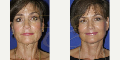 Woman treated with Mini Facelift - Woman treated with Mini Facelift