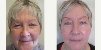 Woman treated with Mini Facelift - Woman treated with Mini Facelift
