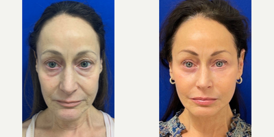 56 year old woman treated with Laser Resurfacing - 56 year old woman treated with Laser Resurfacing through CO2 Laser as well as Eyelid Surgery through upper and lower blepharoplasty, Facelift, Neck Lift, and Facial Fat Transfer, shown 8 months post op.