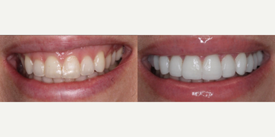 Woman treated with Porcelain Veneers - She felt the entire right side of her smile disappear when she smiled and she desired something fuller and more vibrant. We were able to achieve this camouflage of her lip asymmetry and create more aesthetic harmony with laser gum recontouring and 12 very conservative minimal prep veneers.