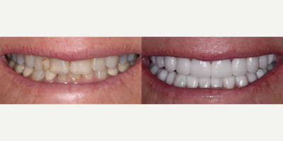 65-74 year old woman treated with Smile Makeover, Porcelain Veneers - Our biggest pro-aging and anti-aging secret when it comes to beauty is restoring youth, health, and function to the smile. This 71-year-old boss babe traveled in from out of state to see us for her smile makeover. Here we did a full mouth reconstruction with 28 porcelain restorations opening her bite for better function, replacing old crowns, fixing chipping, broadening the smile, and going brighter to match her complexion hair, and eye color. This gave her more lip and lower facial support and enhanced her entire face. These pics are immediately post-op and the tissue still healing.