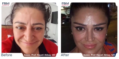 45-54 year old woman treated with Deep Plane Facelift, Facelift, Eyelid Surgery, Rhinoplasty, Facial Fat Transfer - 45-54 year old woman treated with Deep Plane Facelift, Facelift, Eyelid Surgery, Rhinoplasty, Facial Fat Transfer