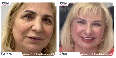 55-64 year old woman treated with Deep Plane Facelift, Facelift, Eyelid Surgery, Facial Fat Transfer - 45-54 year old woman treated with Deep Plane Facelift, Facelift, Facial Fat Transfer, Eyelid Surgery