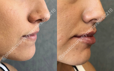 25-34 year old woman treated with Juvederm - Results of lip fillers