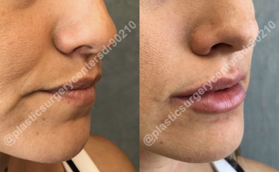 25-34 year old woman treated with Juvederm - Results of lip fillers