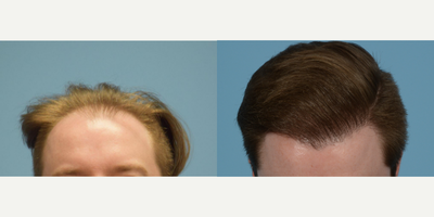 25-34 year old man treated with NeoGraft - 31 year old man treated with an FUE hair transplant using 1,800 grafts and Platelet Rich Plasma therapy. The patient wanted to focus on strengthening his hair line in a natural looking way. The after photo was taken 6 months post procedure with full results expected at 1 year.Individual results may vary.