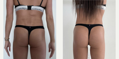 Woman treated with Butt Augmentation - Woman treated with Butt Augmentation using implants