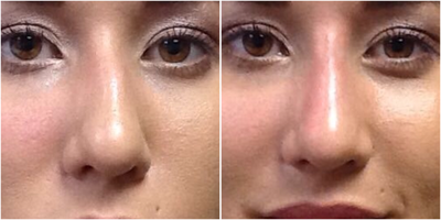 25-34 year old woman treated with Volbella - 25 year old female1 syringe of Juvederm Volbella to correct asymmetry and build the lateral and nasal bridgePhotos taken immediately post injection.
