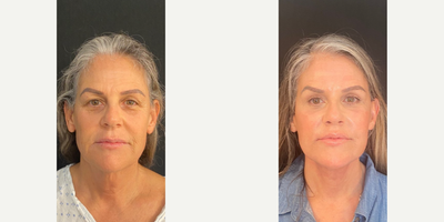 Woman in her early 60s treated with Neck Lift - Woman in her early 60s treated with Neck Lift as well as Deep Plane Facelift to enhance jowls, cheeks, and jawline, Lateral Brow Lift to open up her eyes, Facial Fat Transfer to tear troughs and cheeks junction, Lip Lift for a youthful pout, and CO2 Laser Resurfacing to improve texture of skin.