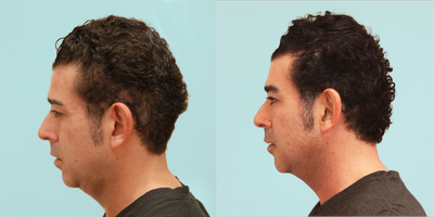 Mesotherapy Injection to Dissolve the Fat  - Mesotherapy injection to dissolve the neck fat.  No operation was done on this patient. This patient had a reduction of fat under his chin and in the neck with a single injection that dissolves the fat.