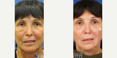 Woman treated with Restylane Contour, Brow Lift - She is now 2 weeks post @Botoxcosmetic to the crow's feet (chemical browlift) and platysma, and @Restylaneusa HA filler to the cheeks, nasolabial folds, and Ristow's space (to address age-related bone loss of the midface). She was also stared on a @zoskinhealth regimen to help with pigmentation and fine lines/wrinkles, and is loving her refreshed look! 
