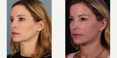 45-54 year old woman treated with Mini Facelift, MACS Facelift, SMAS Facelift - MACS facelift, mini-facelift B&A.