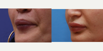 25-34 year old woman treated with Lip Fillers - Removal of deformity due to silicone lip injections