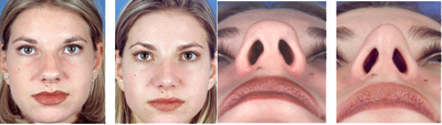 Rhinoplasty - 
	Nose surgery - front view and view of nasal tip
