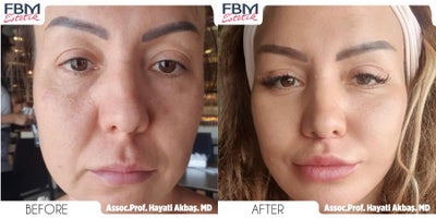 45-54 year old woman treated with Facelift, Eyelid Surgery, Canthoplasty, Lip Lift, Facial Fat Transfer - 45-54 year old woman treated with Facelift, Eyelid Surgery, Canthoplasty, Lip Lift, Facial Fat Transfer