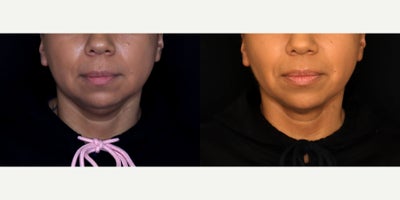 41 year old woman treated with Liposuction, PrecisionTx - 41 year old female treated with submental liposuction (Precision tx) Photos depict before and 6 months after surgery