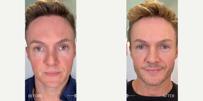 25-34 year old man treated with Lightsheer Laser - Our patient is a TV host on AGT, and wants to look his best on camera. He has been coming to us for nearly 8 years because he always gets the best results. His main concerns are redness and brown spots on his skin. To maximize results, our patient followed his Advalight treatment with the Emer Skin Illuminating Mask. This is how his skin reached that angelic level. He also used some other products from Emer Skin to further enhance his results. He is absolutely loving his results and all of Dr. Emer's after care products that helped him glow on the red carpet!