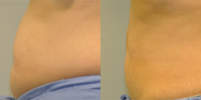 45-54 year old woman treated with Vanquish - 45 year old patent treated with Vanquish and CoolSculpting combined, also called Fire and Ice.