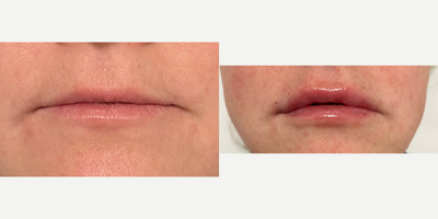35-44 year old woman treated with Revanesse - 35-44 year old woman treated with Revanesse