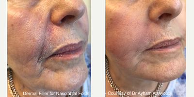 55-64 year old woman treated with Dermal Fillers, Ellanse - The before and after photos above are an example of Dermal Filler treatment using Ellanse by Mr Ayham Al-Ayoubi. The results vary from one patient to another and there is no guarantee that all patients, who will have the procedure will have similar results.https://www.lmaclinic.com/ellanse