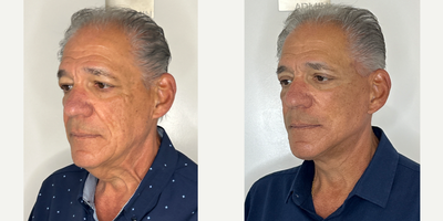 65-74 year old woman treated with Facelift, Neck Lift, Facial Fat Transfer, Eyelid Surgery - My 73 year old patient is 2 months post Facelift, Neck lift, Facial Fat Transfer and Upper Blepharoplasty.