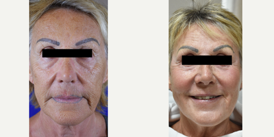 Sciton Erbium Laser Resurfacing for wrinkles, Los Angeles before and after - Wow!  Look at what two Sciton Erbium laser resurfacing procedures and a q-switched laser to remove discolored permanent makeup can do.  At least 15 years younger!  Call us today to learn more about these procedures.