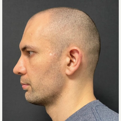 35-44 year old man treated with Chin Implant - Genioplasty